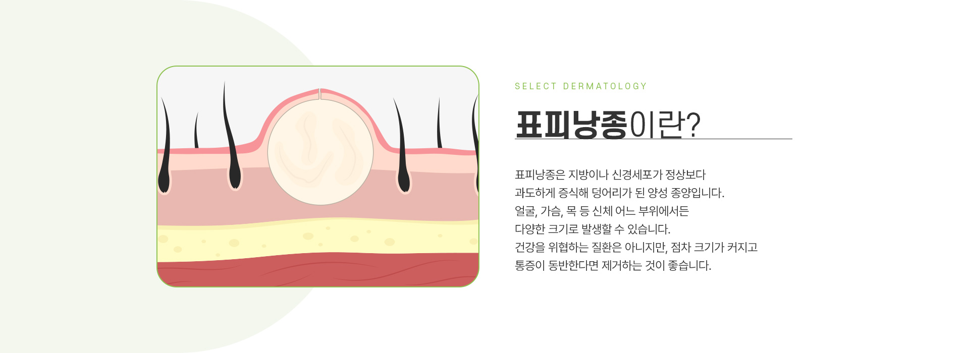 표피낭종 주의