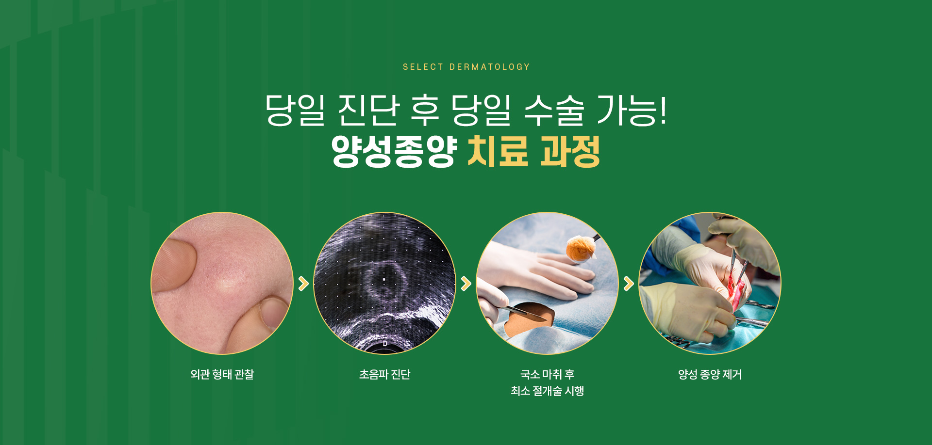 표피낭종 주의