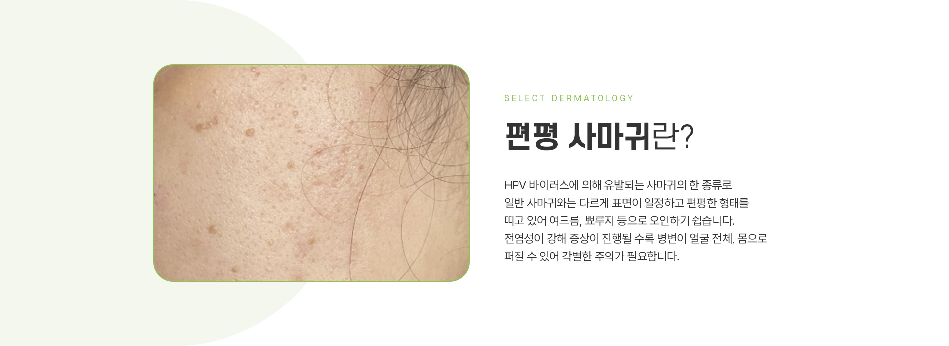 편평사마귀 주의