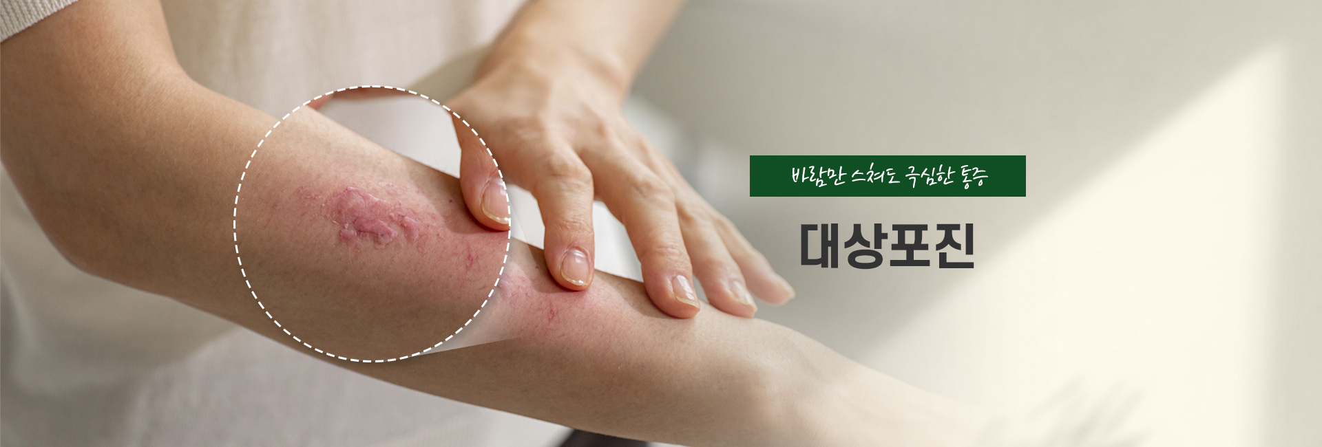 대상포진 키비주얼