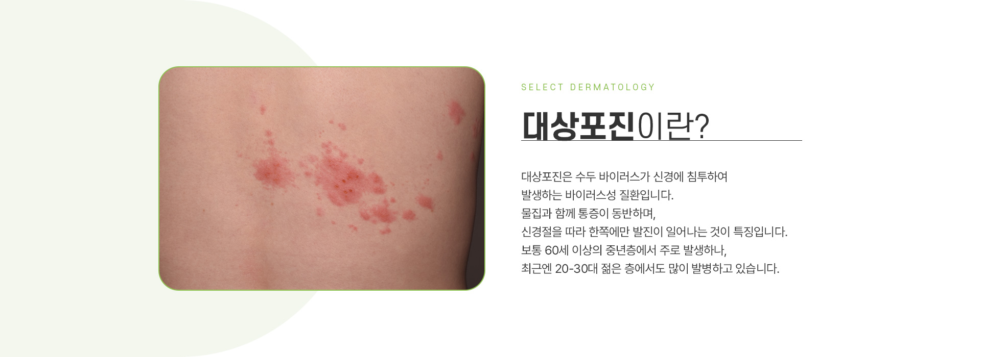 대상포진 주의