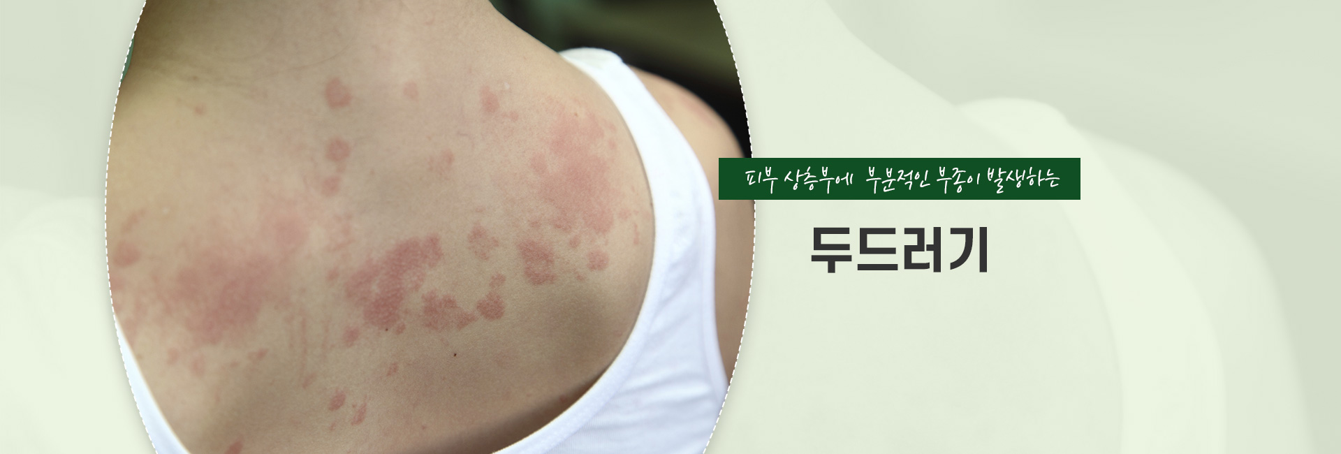 두드러기 키비주얼