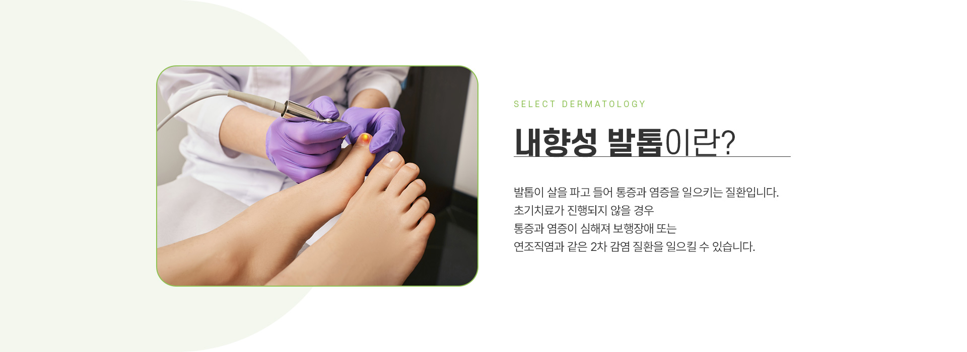 내성발촙 주의