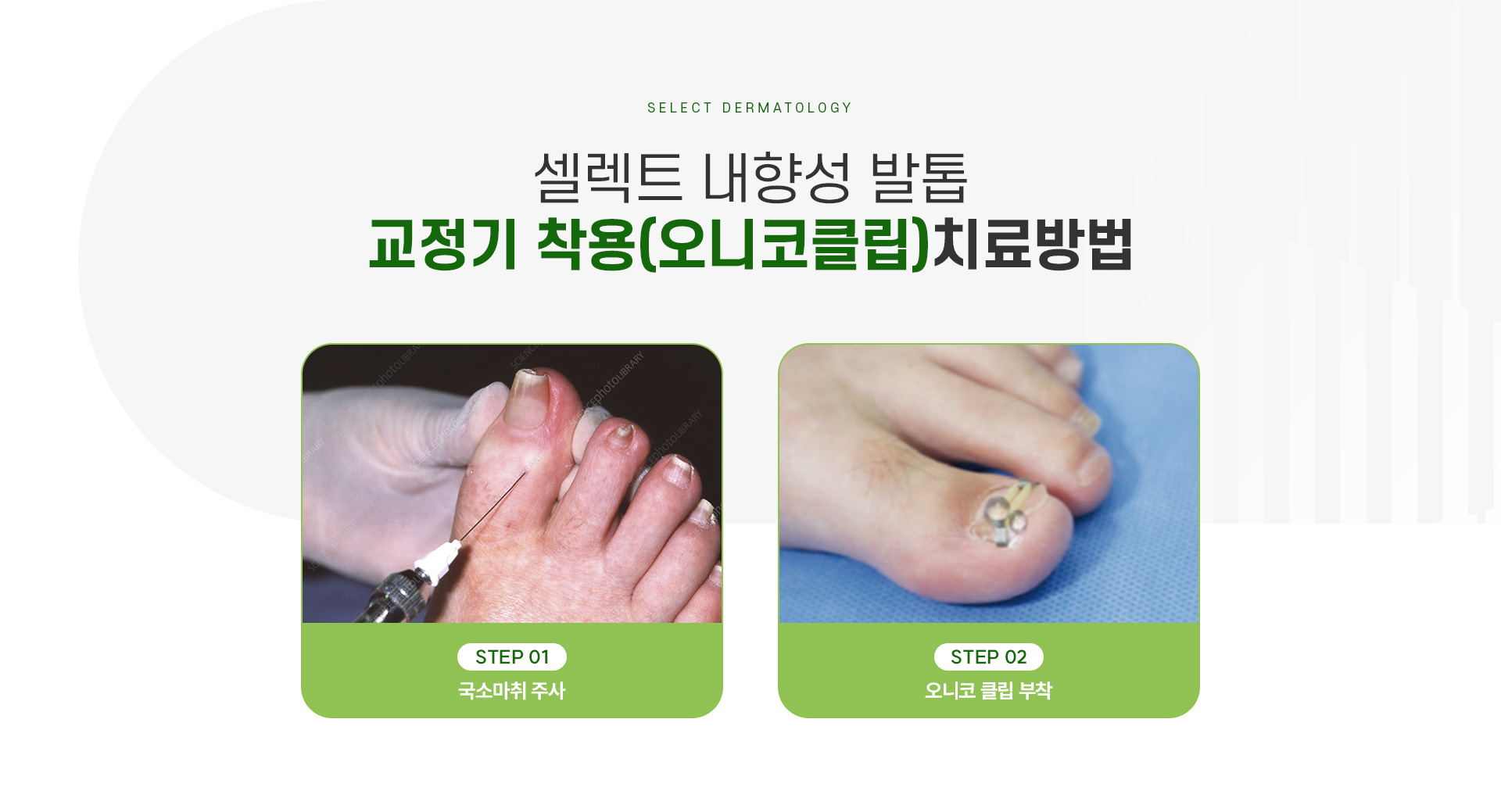 내성발촙 치료방법