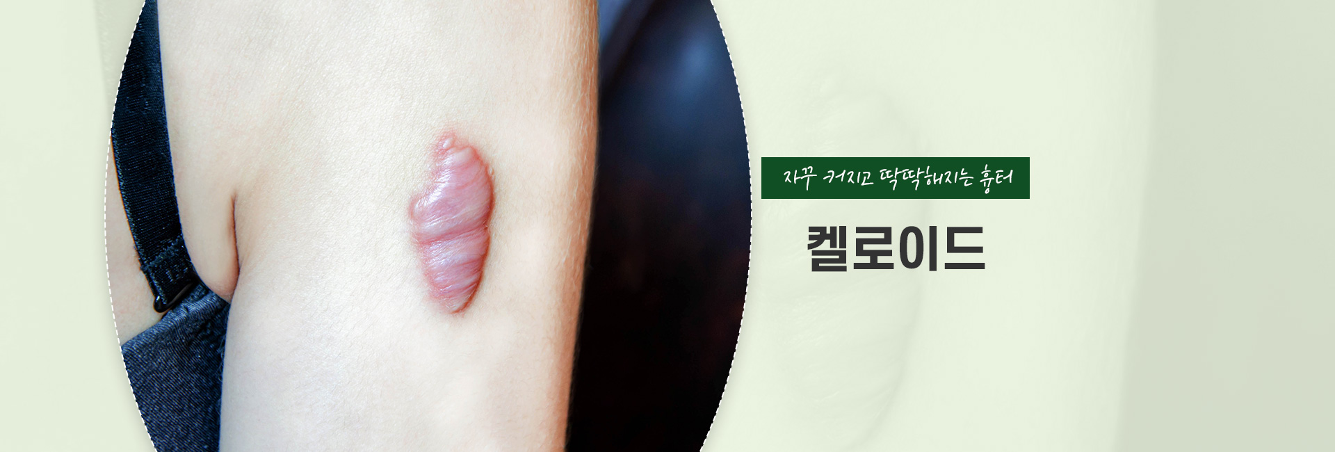 켈로이드 키비주얼