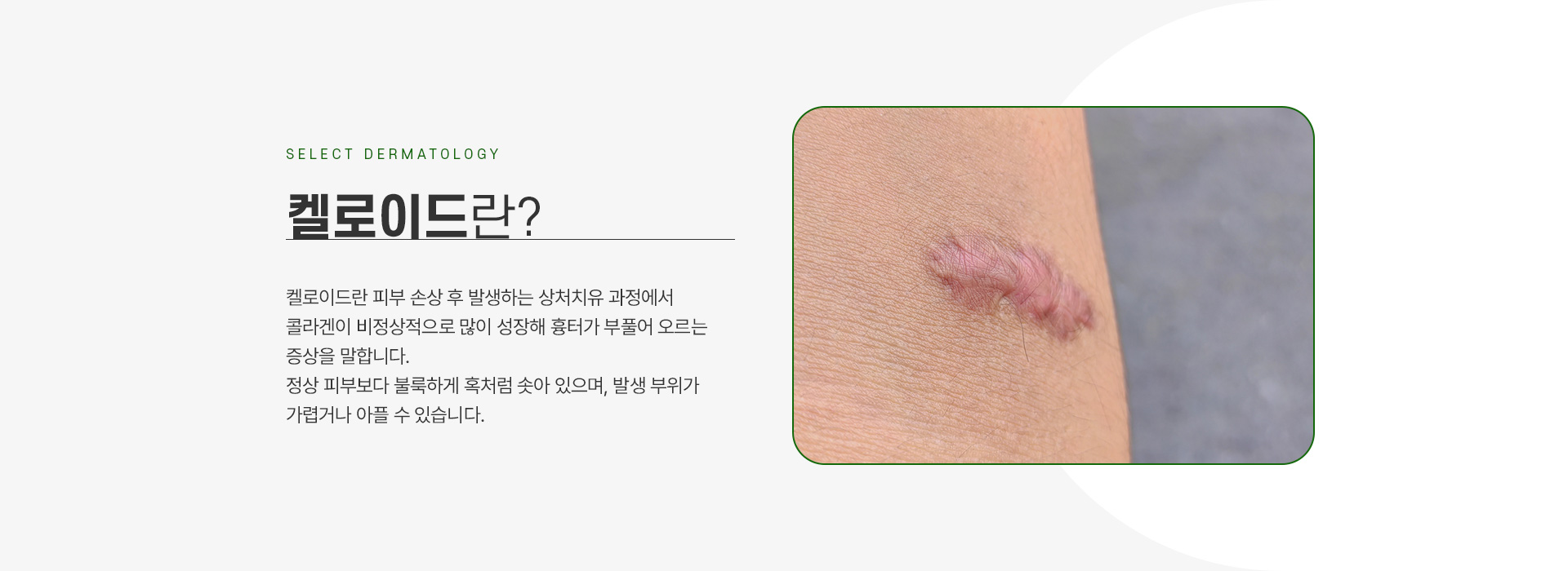 켈로이드 주의