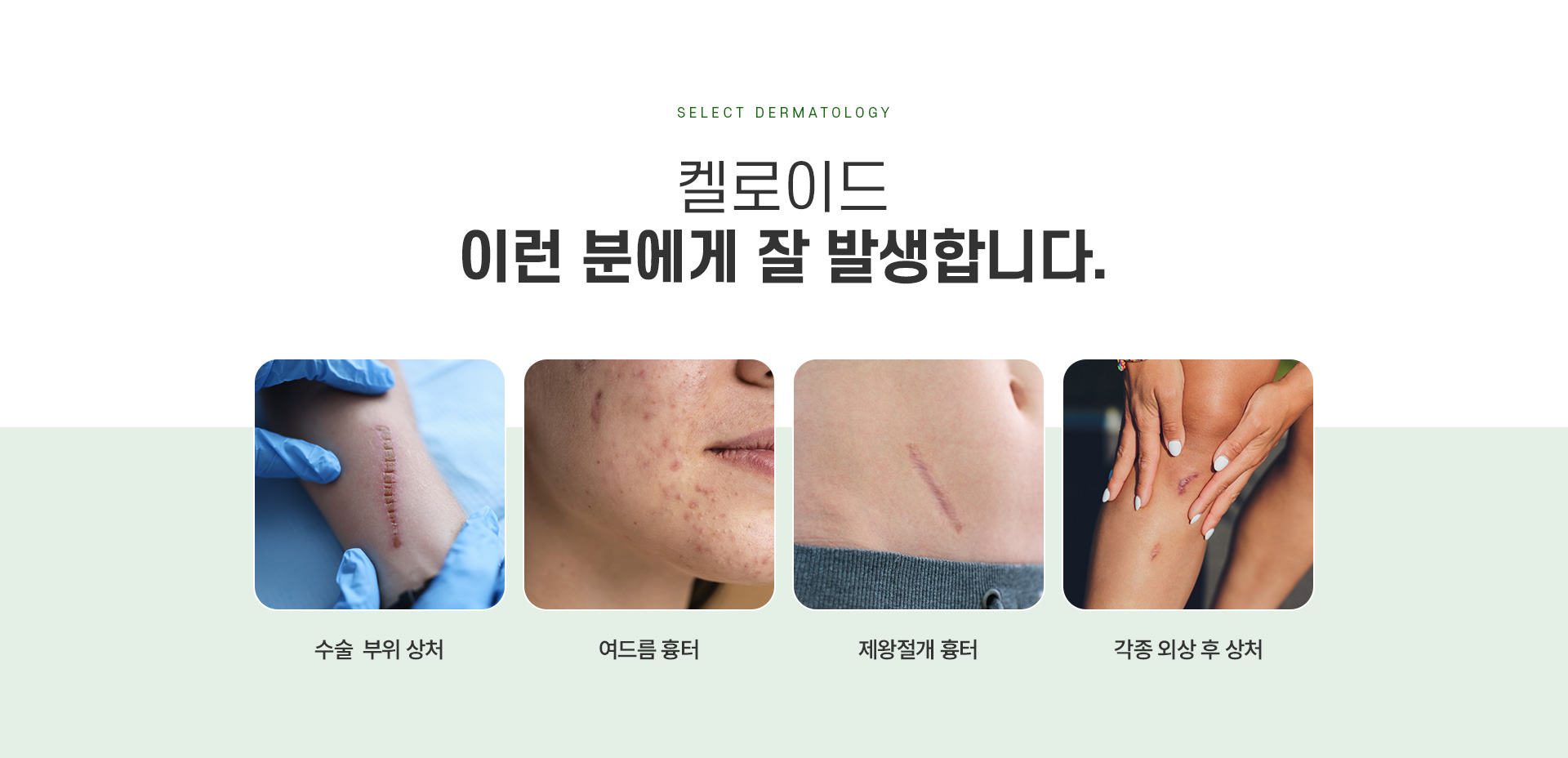 켈로이드 주의