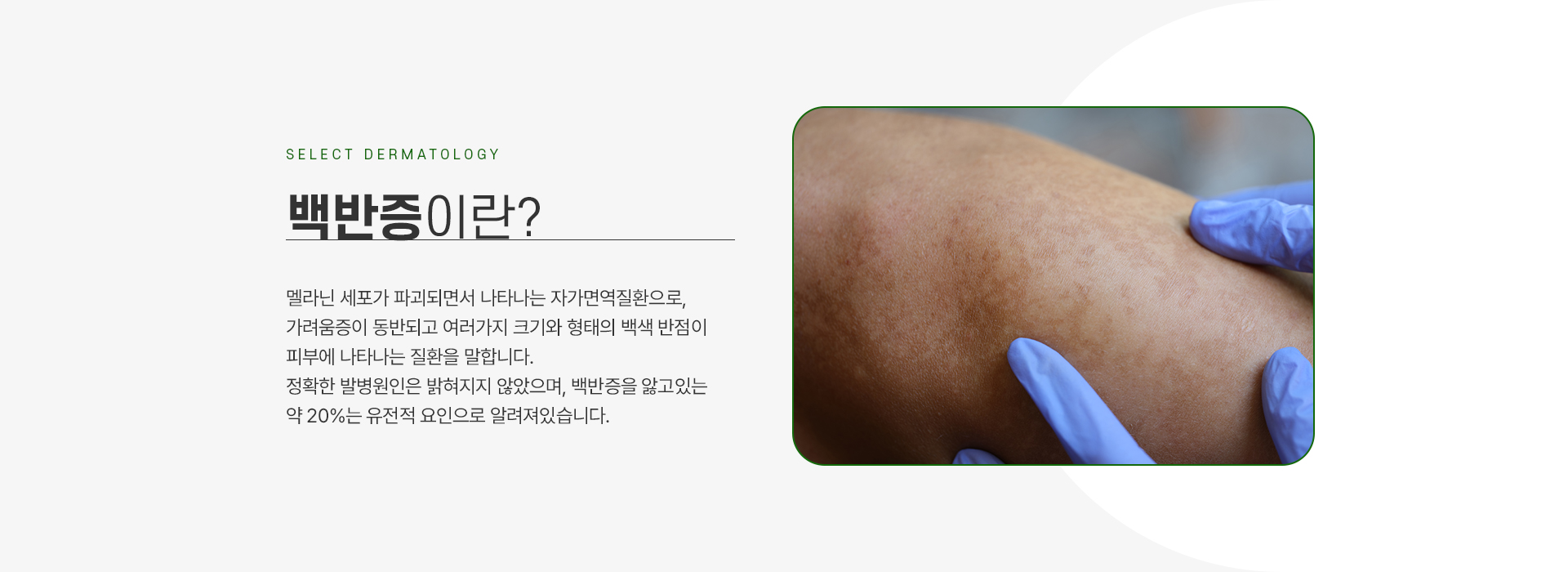 백반증 주의