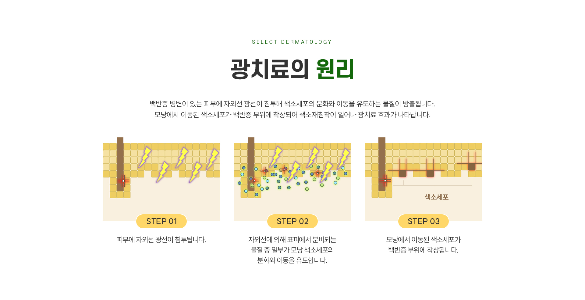 백반증 치료방법