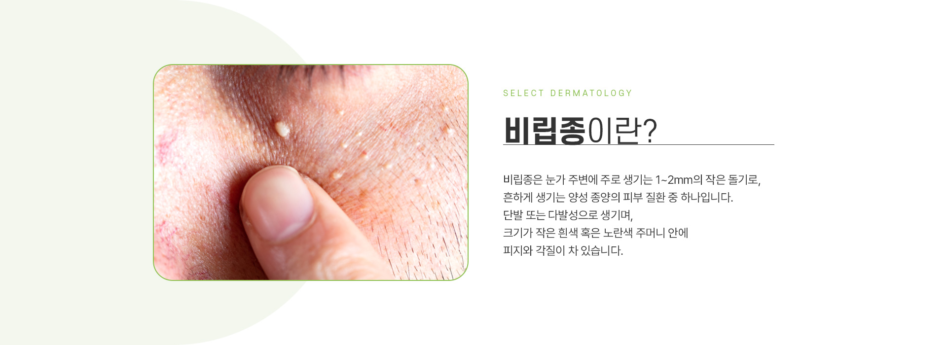 비립종 주의