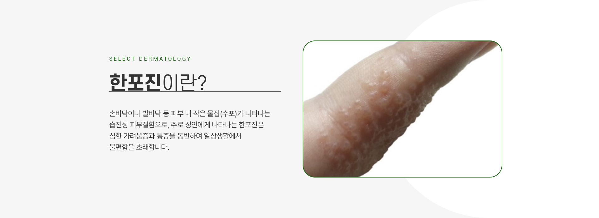 한포진 주의