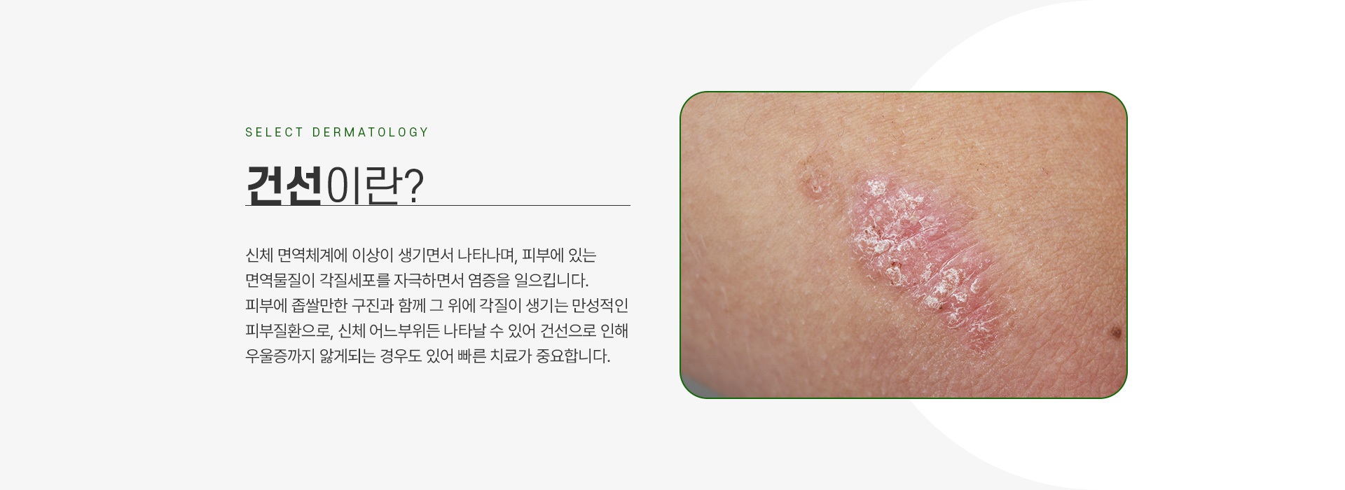 건선 주의