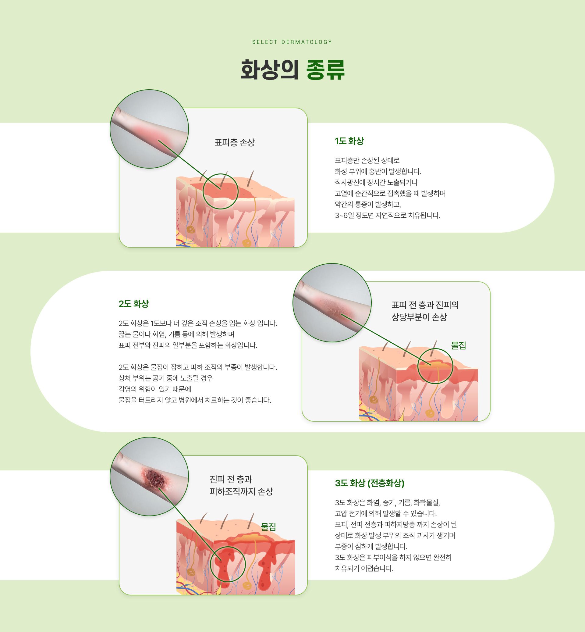 화상 주의