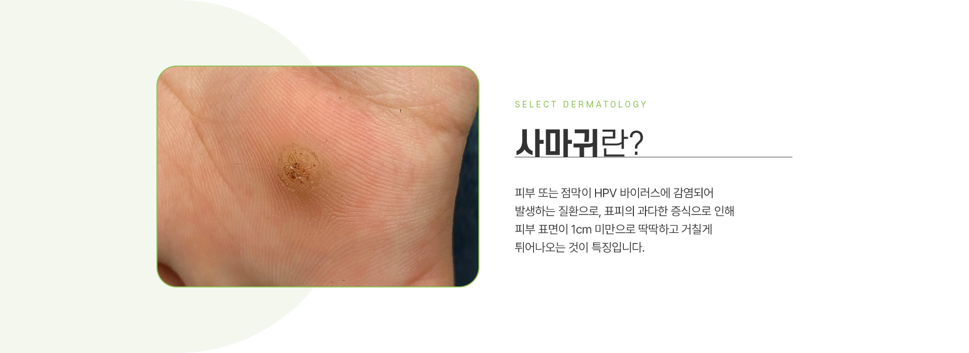 사마귀/티눈 주의