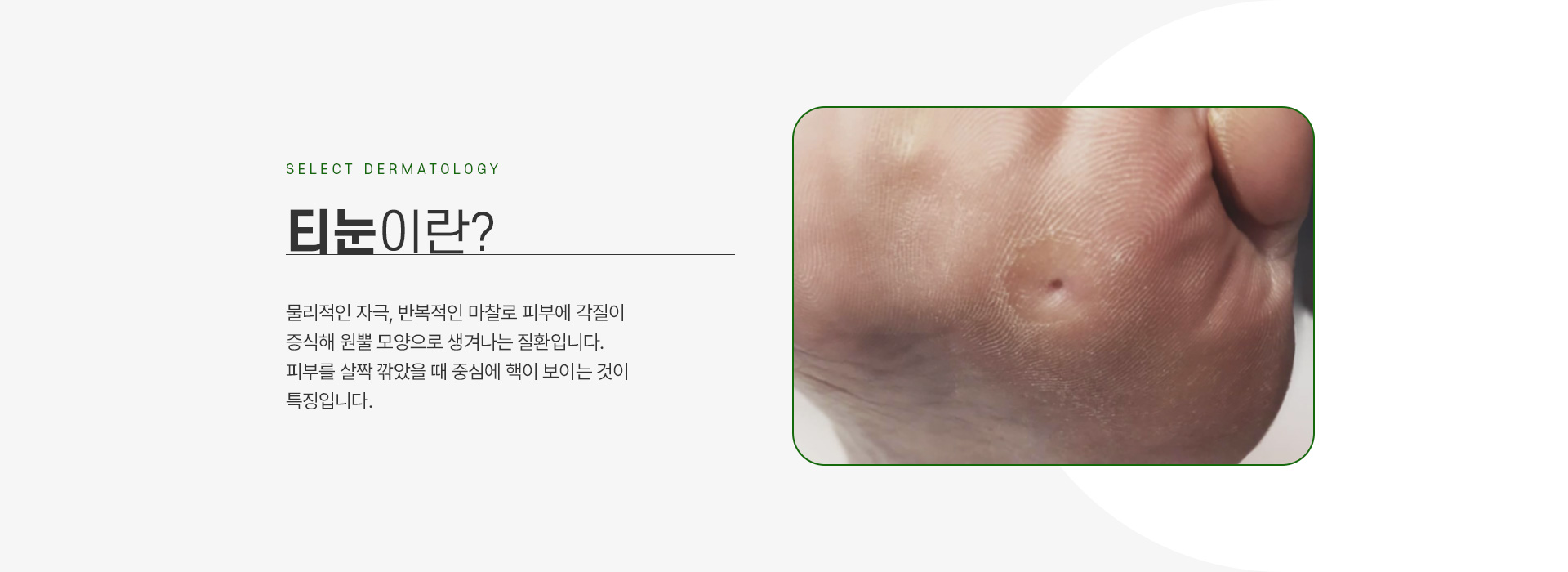 사마귀/티눈 주의