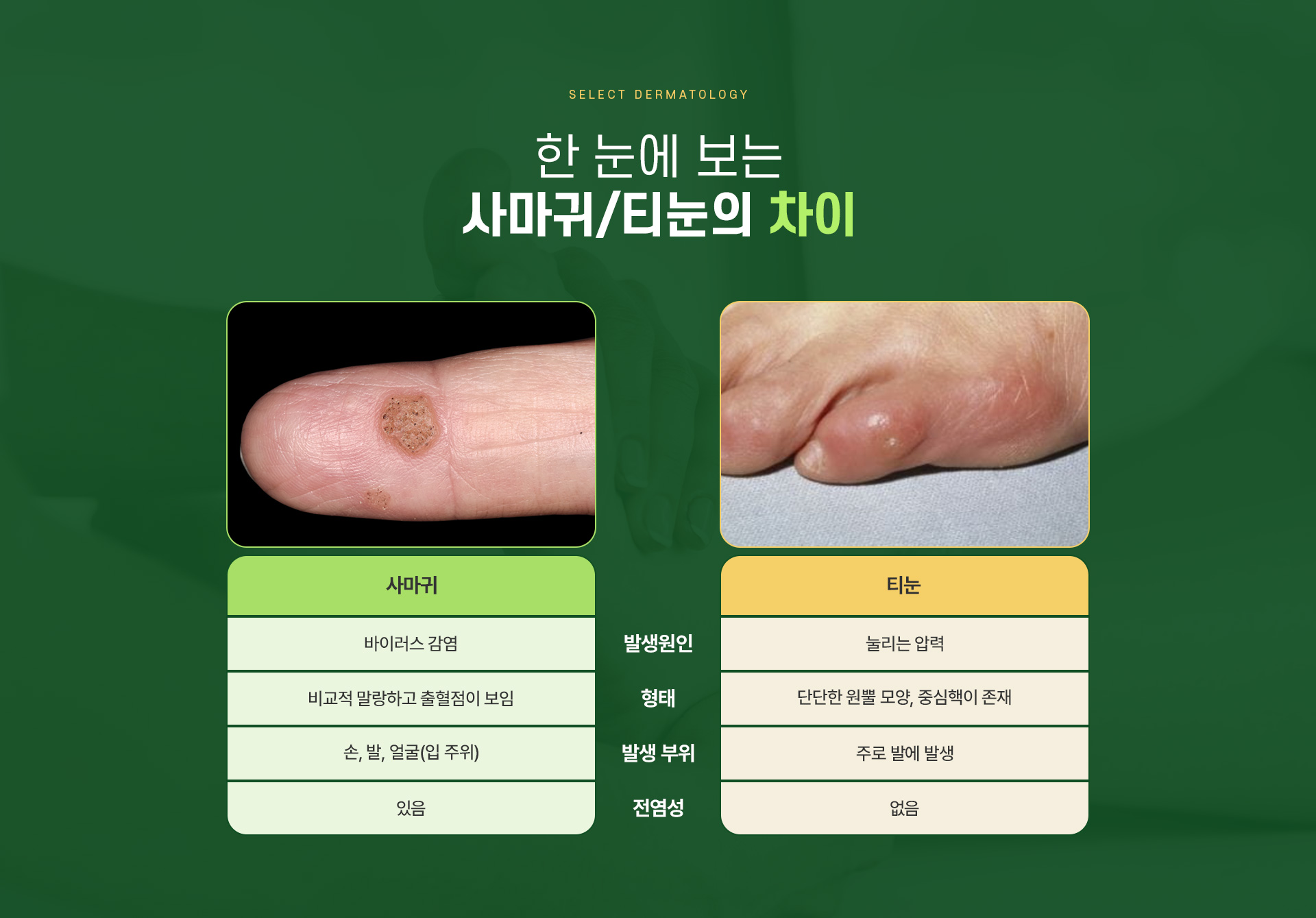 사마귀/티눈 치료방법
