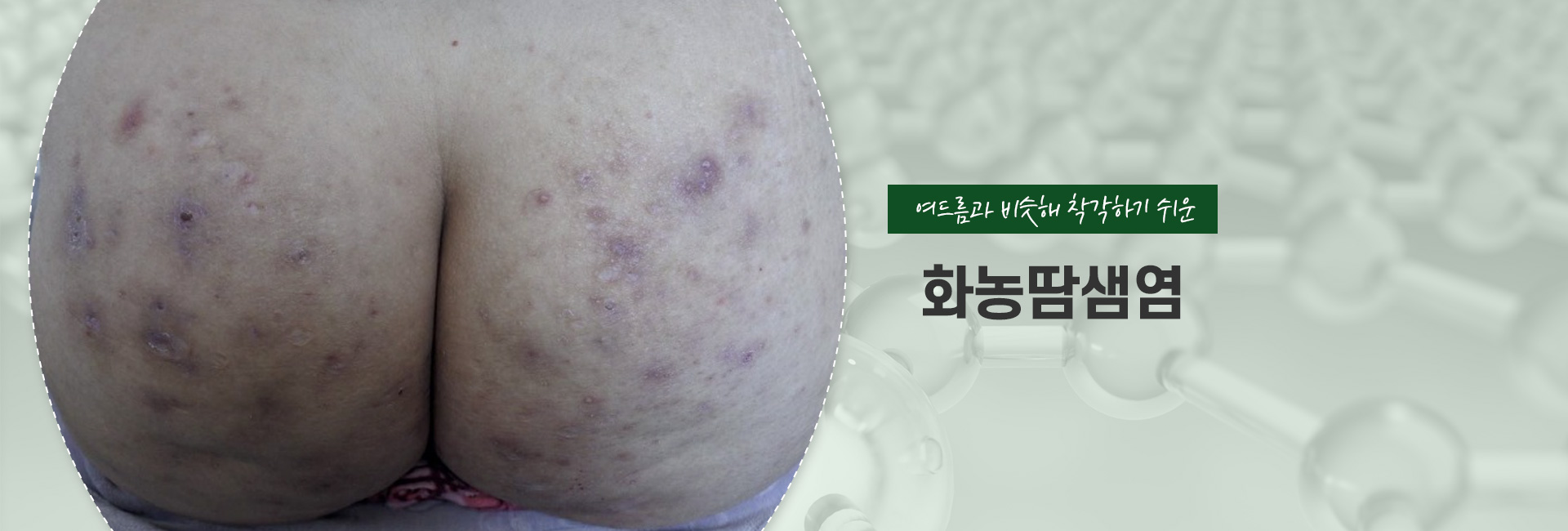 화농땀샘염 키비주얼