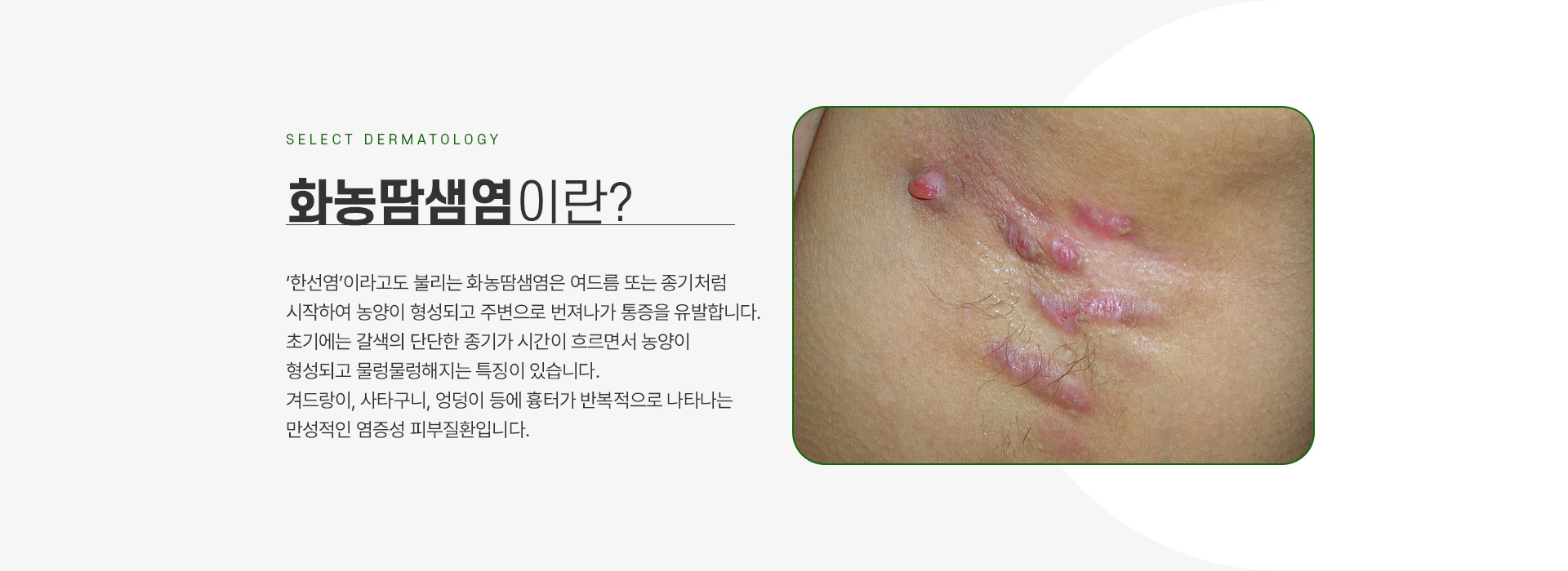 화농땀샘염 주의