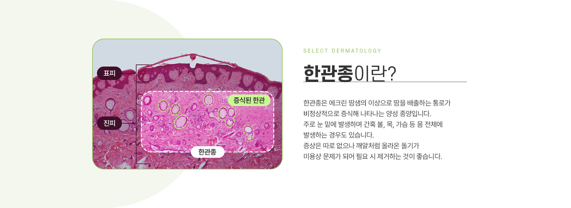 한관종 주의