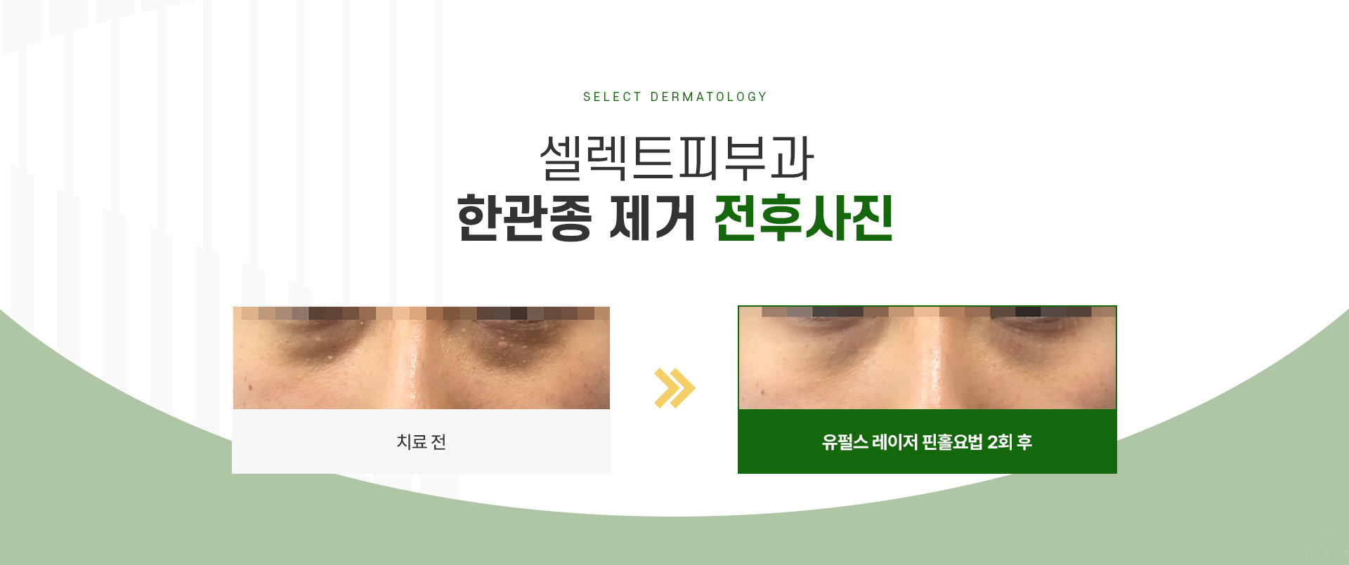 한관종 전후사진