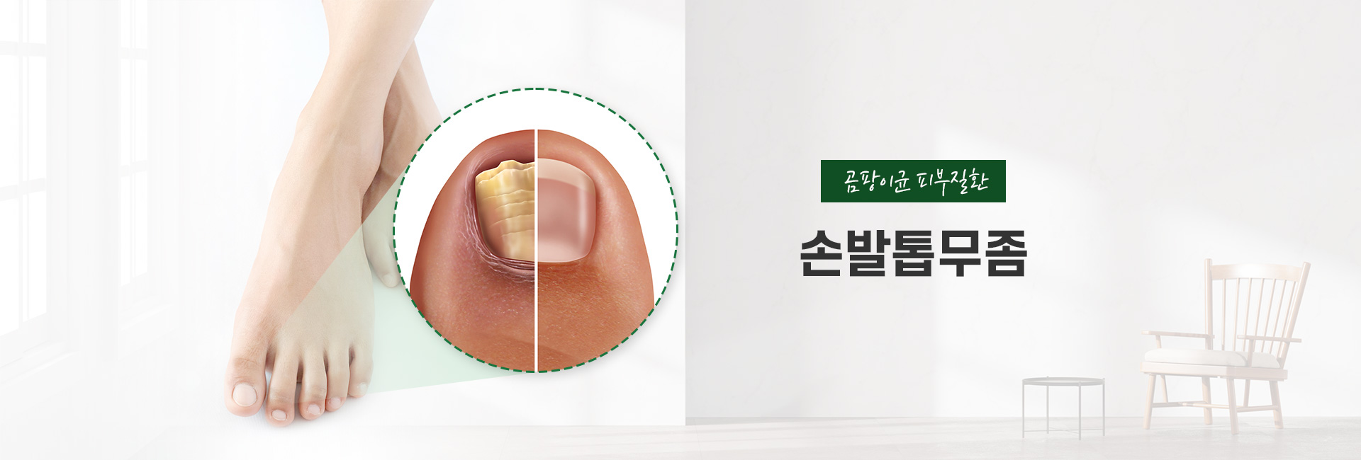 무좀 키비주얼