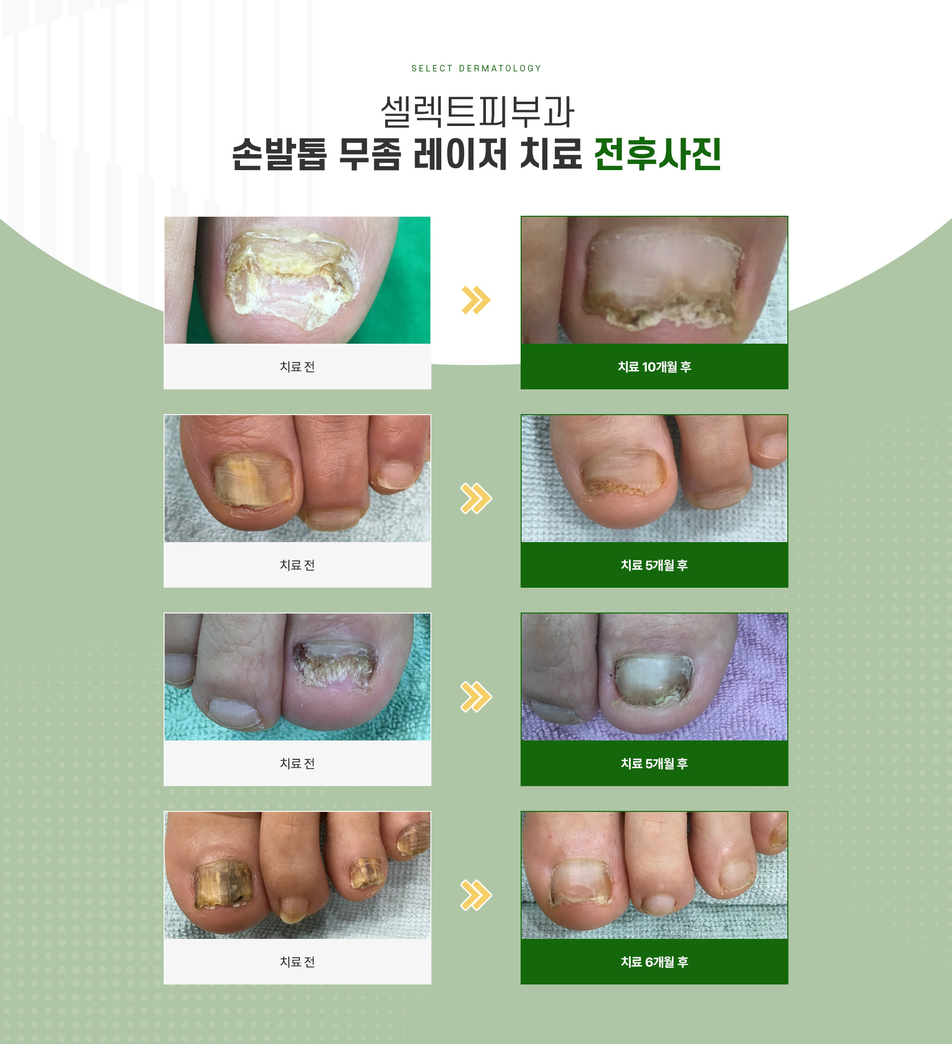 무좀 전후사진