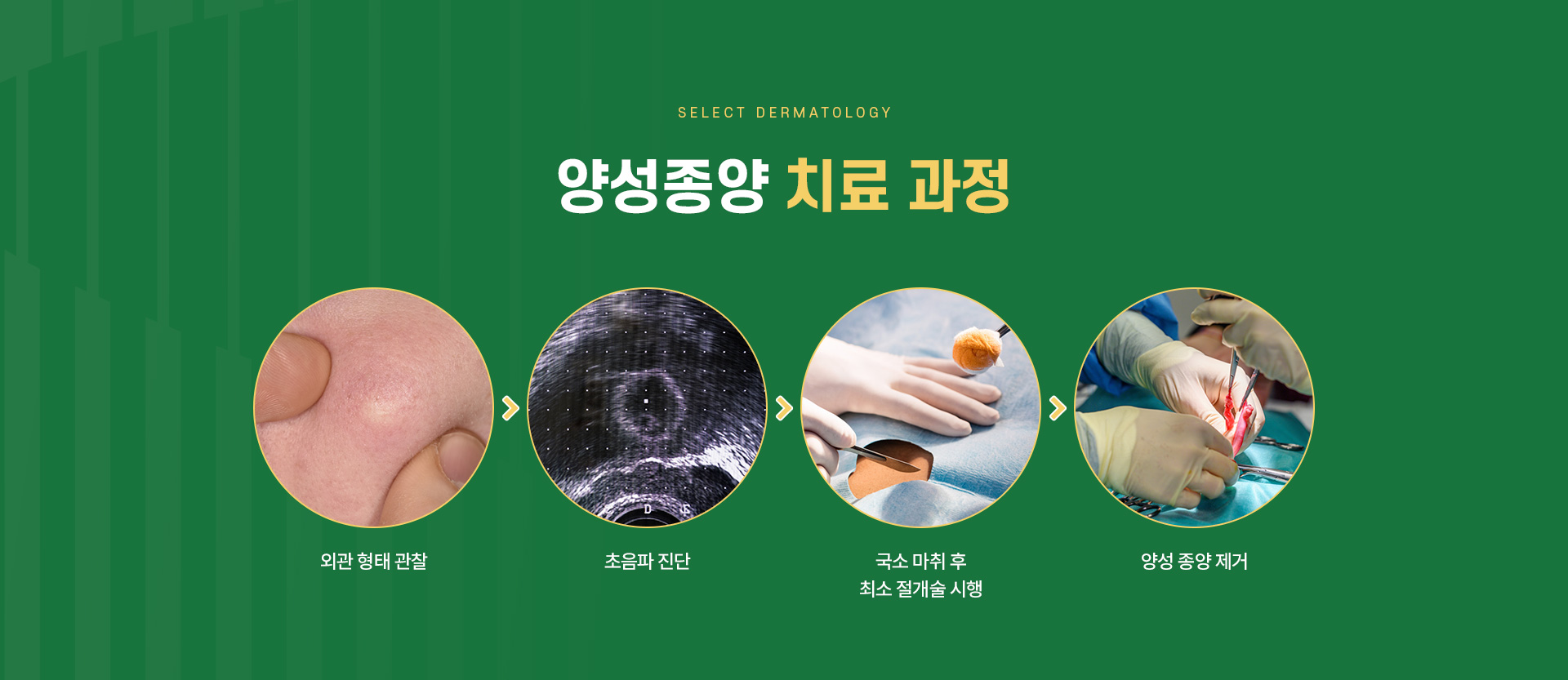 기타양성종양 주의